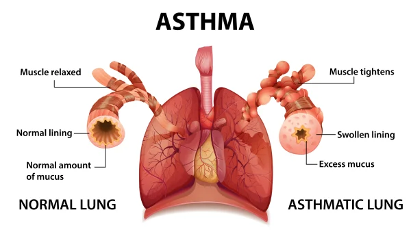Asthma and Lung UK